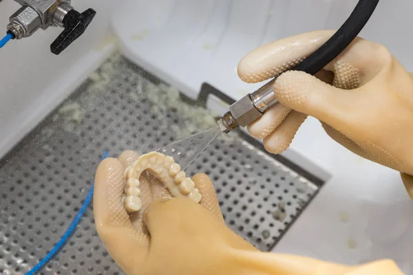 Técnico dental limpia el puente de implantes dentales impresos en 3D — Foto de Stock