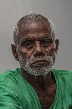 Sundarpur, Hindistan - 2013: Hindistan 'ın Bihar eyaletindeki yerel bir cüzzamlı hastanesinde kimliği belirsiz Hintli cüzzamlı hastalar