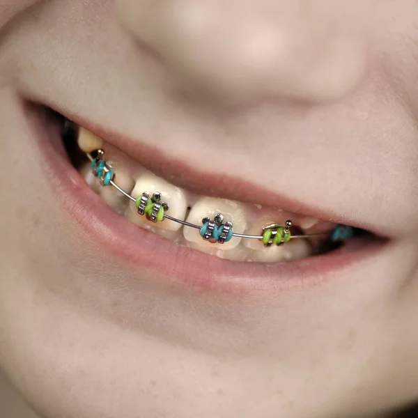 Брекеты на зубах молодой девушки — стоковое фото