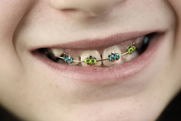 A fiatal lány fogak fogszabályozó — Stock Fotó