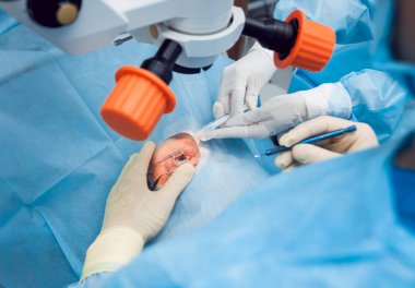 Kadın kıdemli çalışma gözde. Katarakt ameliyatı. Tıbbi donatımı. 