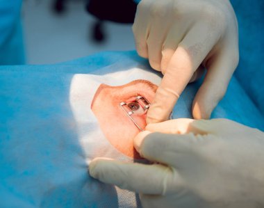 Kadın kıdemli çalışma gözde. Katarakt ameliyatı. Tıbbi donatımı. 