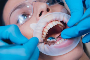 Expander ile diş tedavisi. Modern teknoloji