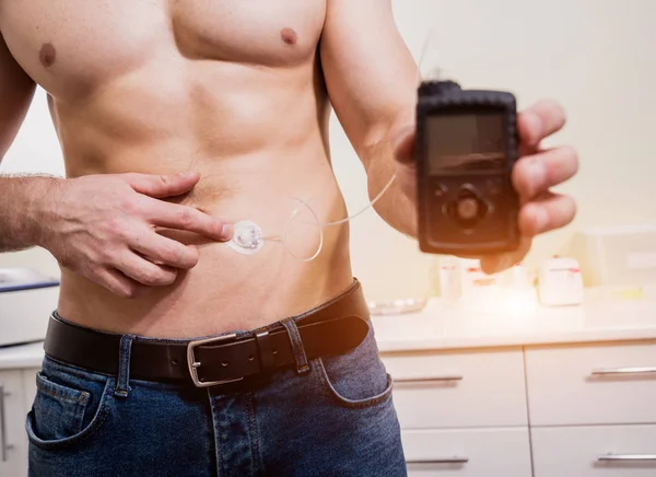 Diabetische man met een insulinepomp die in zijn buik is aangesloten en de insulinepomp houdt — Stockfoto