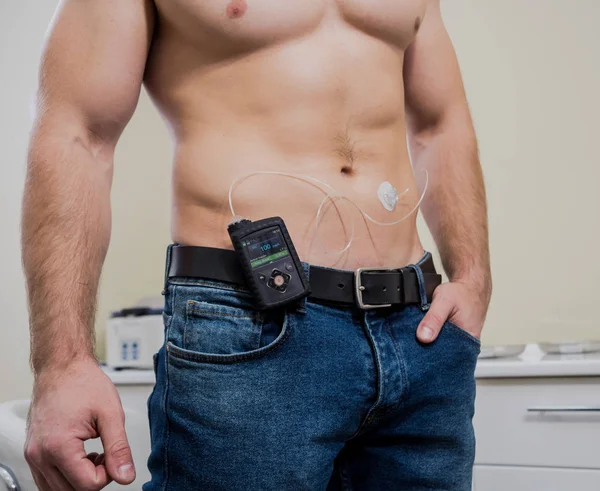 Diabetiker mit einer im Bauch angeschlossenen Insulinpumpe, die die Insulinpumpe am Laufen hält — Stockfoto