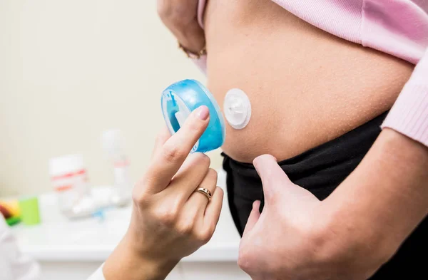 Arzt installiert Insulinkatheter für eine einfache Insulinspritze. — Stockfoto
