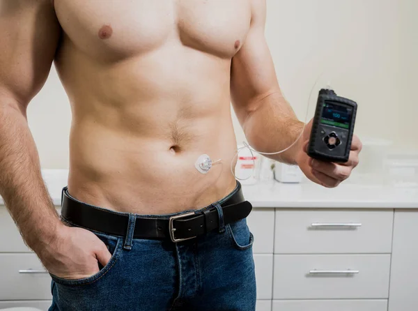 Діабетична людина з інсуліновим насосом, з'єднаним у животі — стокове фото