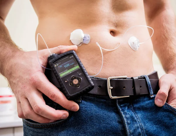 Diabetic man with an insulin pump connected in his abdomen — ストック写真