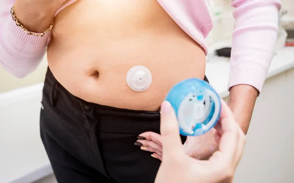 Arzt installiert Insulinkatheter für eine einfache Insulinspritze. — Stockfoto