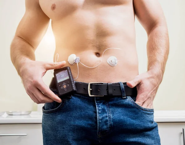 Diabetiker mit Insulinpumpe im Bauch — Stockfoto