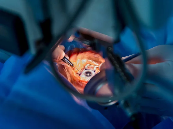 A operação no olho. Cirurgia da catarata — Fotografia de Stock
