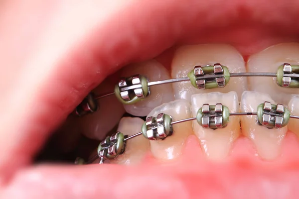 Zahnspange im jungen Mund — Stockfoto