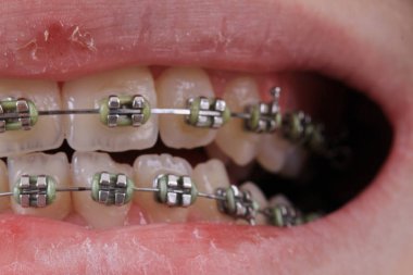 hoş bir diş hekimi arka plan olarak genç ağız diş telleri