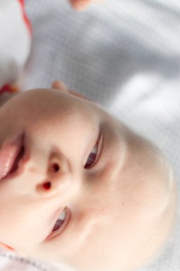 Whitehair babyboy albinizm Sendromu