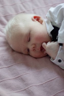 Whitehair babyboy albinizm Sendromu