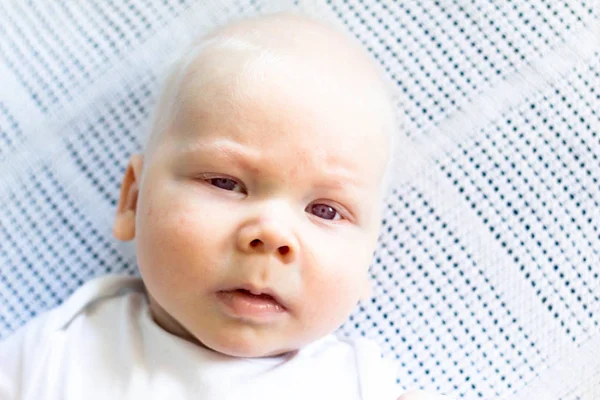 Whitehair babyboy albinizm Sendromu