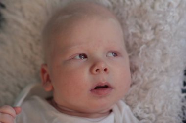 Whitehair babyboy albinizm Sendromu