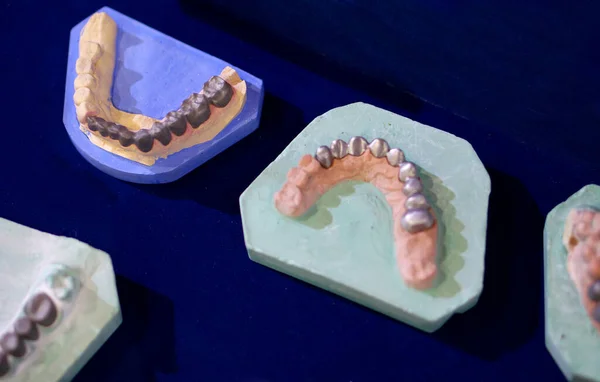 Fabricación Prótesis Dentales Humanas Con Implantes Metálicos —  Fotos de Stock