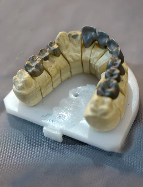 Gros Plan Prothèse Humaine Avec Des Dents Métal — Photo