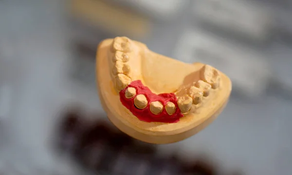 Primer Plano Modelo Prótesis Dentales —  Fotos de Stock