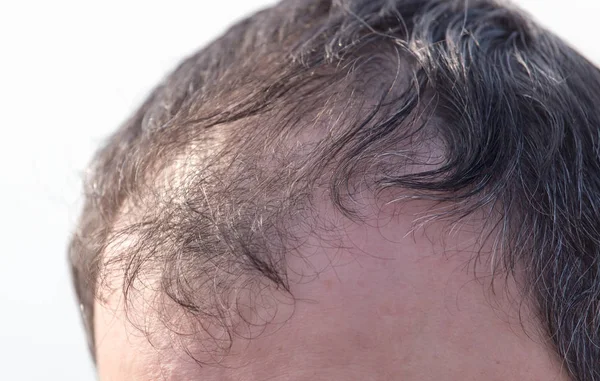 頭の上のはげの斑点 — ストック写真