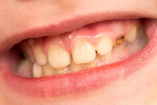Denti da latte. macro — Foto Stock