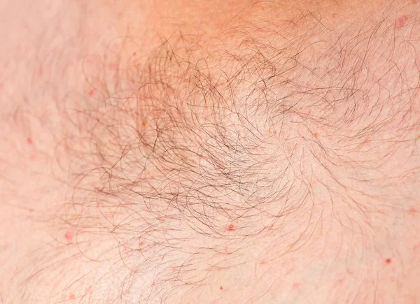 The hair on the human skin as background — Stock Photo, Image