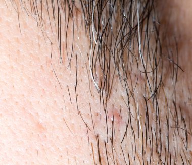 Erkek saç anız. Makro