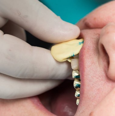 Doktor plastik protez diş hekimliği yapıyor