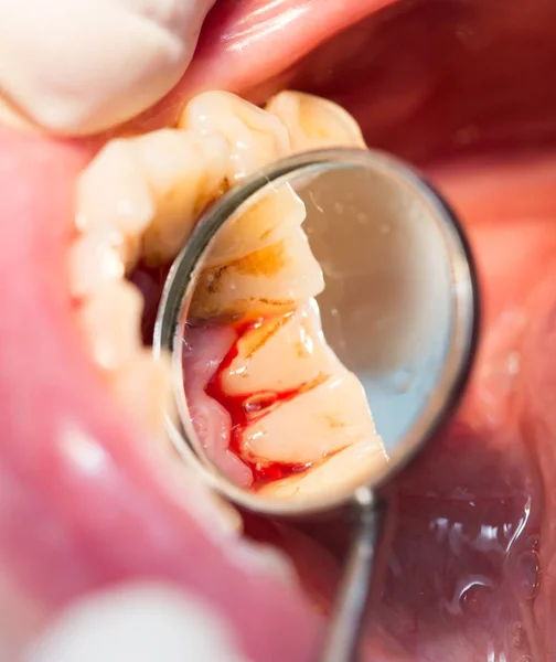 Traitement dentaire en dentisterie — Photo