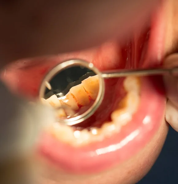 Tratamento dentário em odontologia — Fotografia de Stock