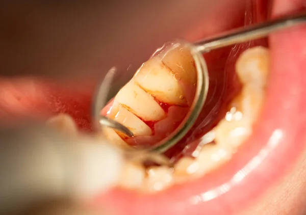 Лечение зубов в стоматологии — стоковое фото
