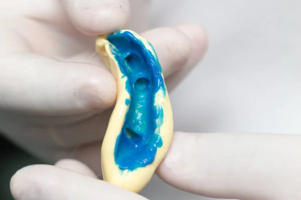 Medico fa una protesi plastica odontoiatria — Foto Stock