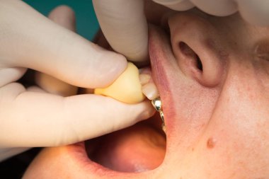 Doktor plastik protez diş hekimliği yapıyor