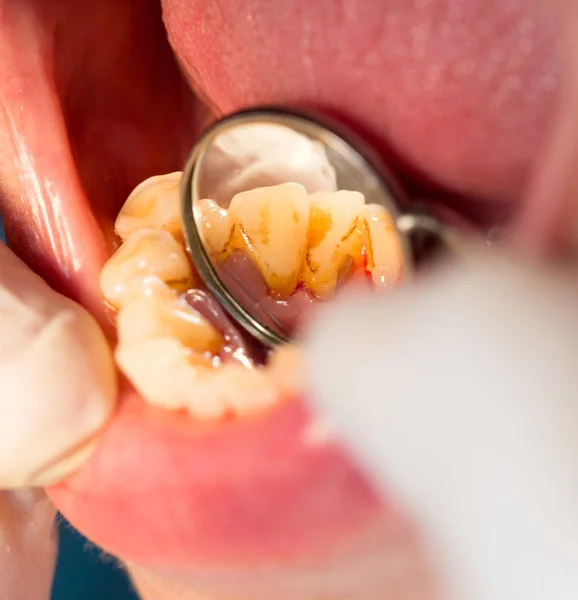 Лечение зубов в стоматологии — стоковое фото