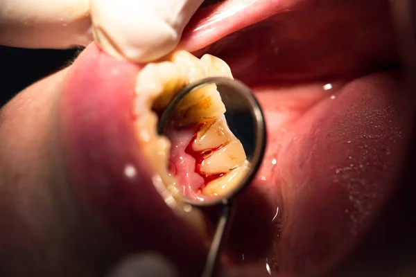 Tratamento dentário em odontologia — Fotografia de Stock