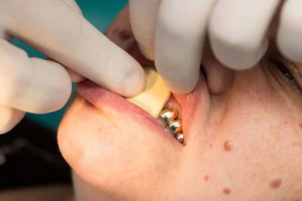 Dokter maakt een kunststof Prothetische Tandheelkunde — Stockfoto