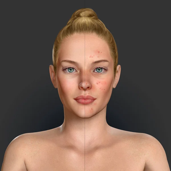 Illustration 3D d'une femme avant et après traitement de l'acné — Photo