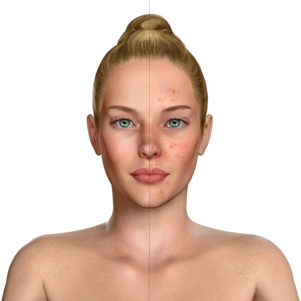 Ilustração 3d de uma mulher antes e depois do tratamento da acne proce — Fotografia de Stock