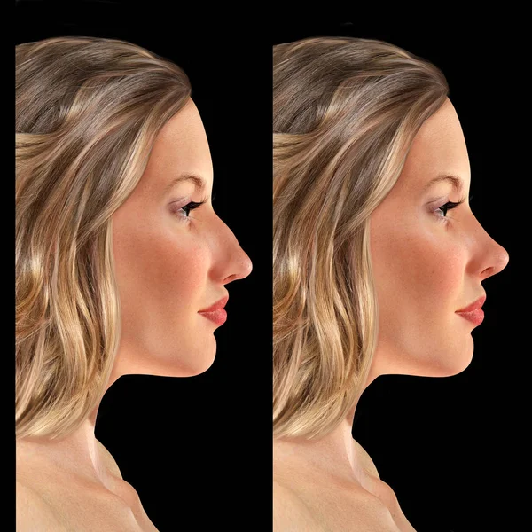 Comparative portrait of a 3d young woman before and after rhinop — Stock Photo, Image