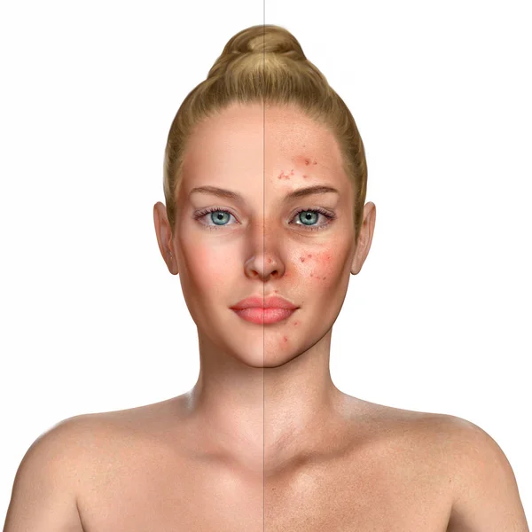 3d illustration of a woman before and after acne treatment proce — Stock Photo, Image