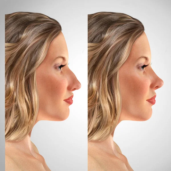 Retrato comparativo de una mujer joven 3d antes y después de rinop — Foto de Stock