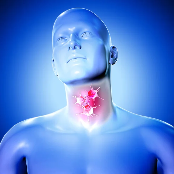 3D medicinsk figur med virus celler på halsont — Stockfoto