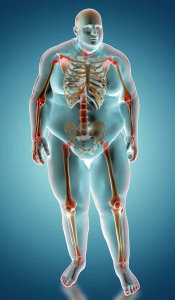 3d illustration of Overweight human anatomy with heighleited pai — 图库照片