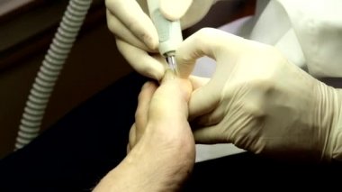 Podologist hastalar çivi ile çalışır