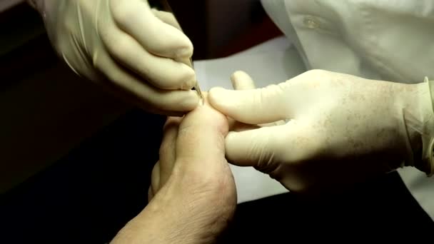 Подолог працює з нігтем пацієнтів — стокове відео