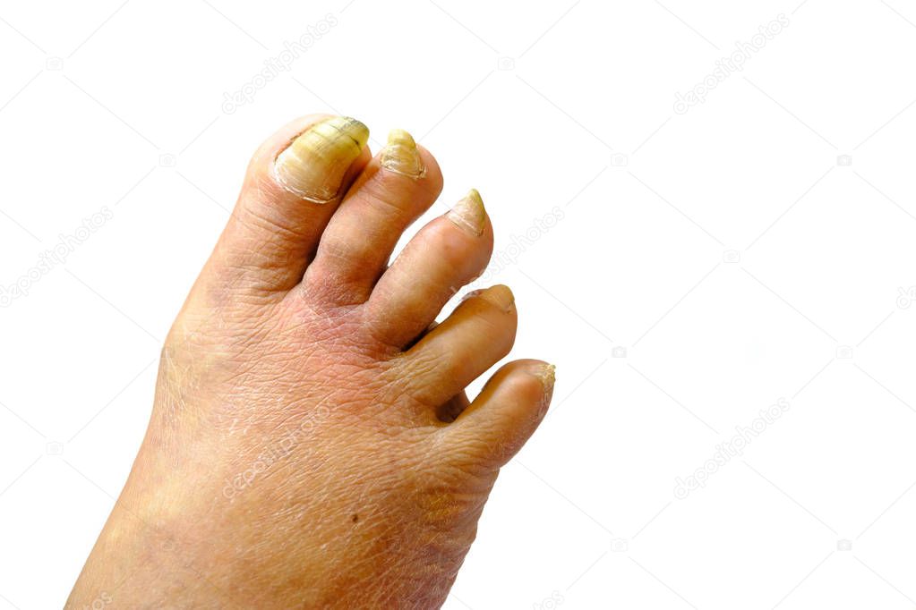 Sick unhealthy nails on the foot of a man