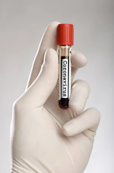 Hand Holding Infected Blood Test Tube Coronavirus — Stock Photo, Image