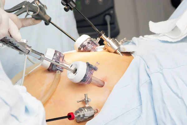 Gastrik bypass cerrahisi