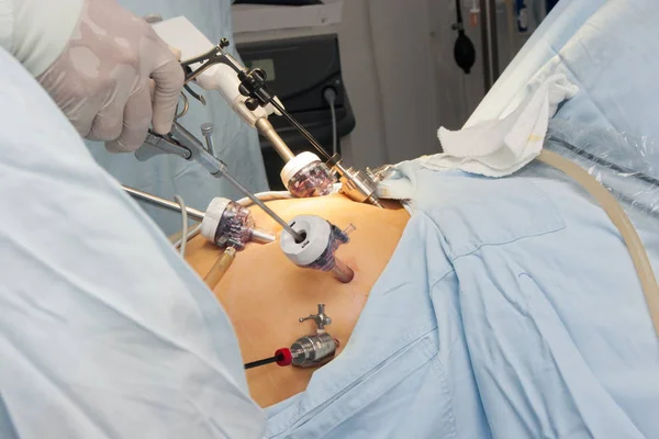 Γαστρική χειρουργική επέμβαση παράκαμψης — Φωτογραφία Αρχείου